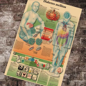 

Medical Anatomy Anatomical Chart Diabetes Mellitus Chart Classic Canvas Paintings Vintage Wall Posters Stickers Home Decor Gift