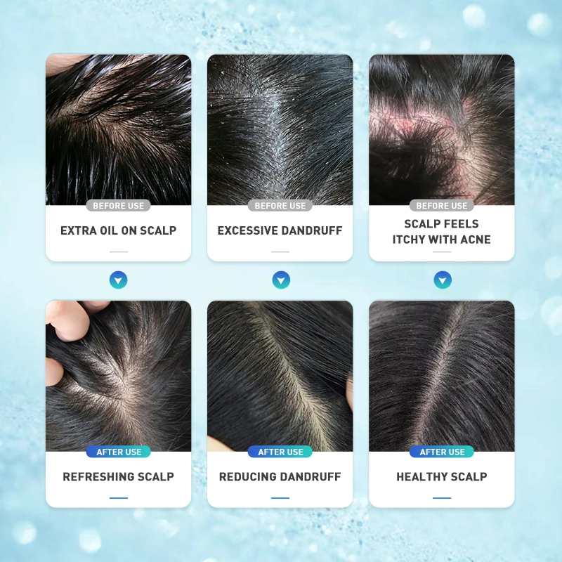 PURC Anti Dandruff Anti Itching Cream Scalp Refreshing Oil Control Gel Exfoliating Scalp Treatment Hair Care Beauty Health