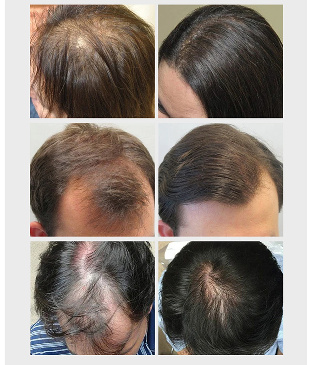 Продукты для выпадения волос натуральные без боковых эффектов растут волосы быстрее восстанавливают средства для роста волос