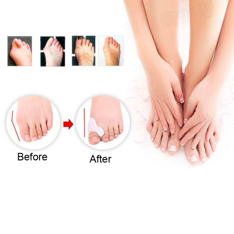 Массажер для ног hallux 2 шт. = 1 пара|hallux valgus pro|gel bunion guardhallux |