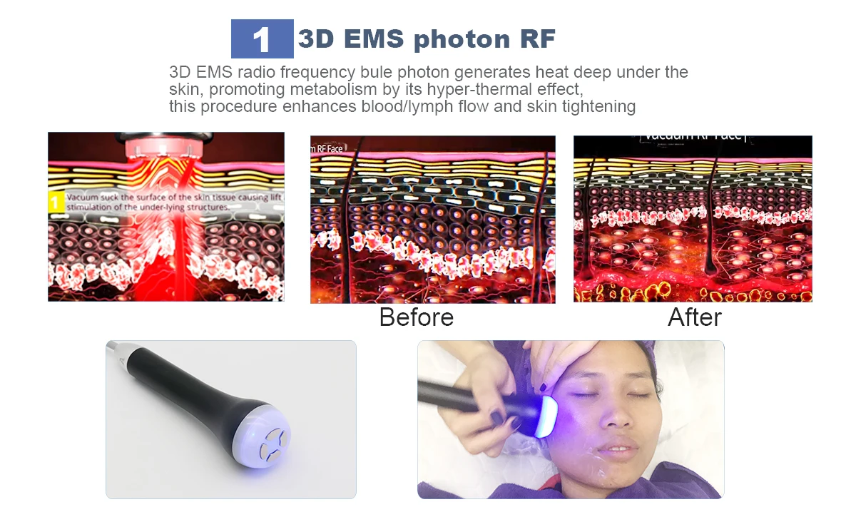 Дизайн 4D Кавитация RF микроскоп EMS ультразвуковая машина для похудения с вакуумом