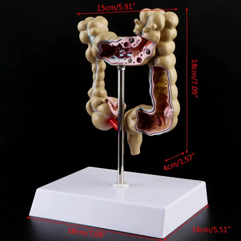 

Colorectal lesion model human colon large intestine pathological diseases model medical organizer anatomy