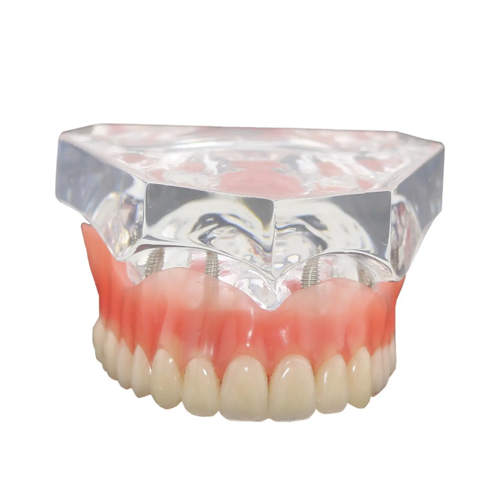 Стоматологическая модель верхних зубов Overdenture Superior 4 имплантата 6001