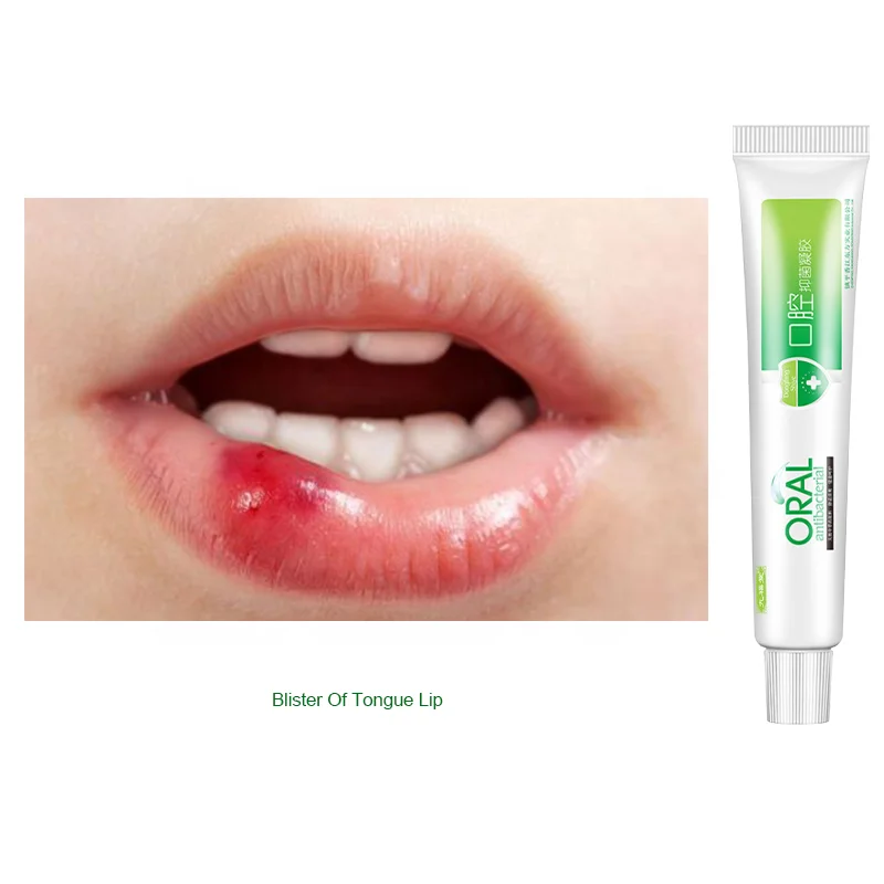 Mouth Ulcer Relief Aloe Vera Gel Natural Aloe Oral Hygiene Breath Bad
