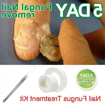 

Chinese Medicine Herbs Toe Nail Fungus Treatment Anti Fungal Nail Infection Essence Nail Treatment Removal Nail Care Lotion