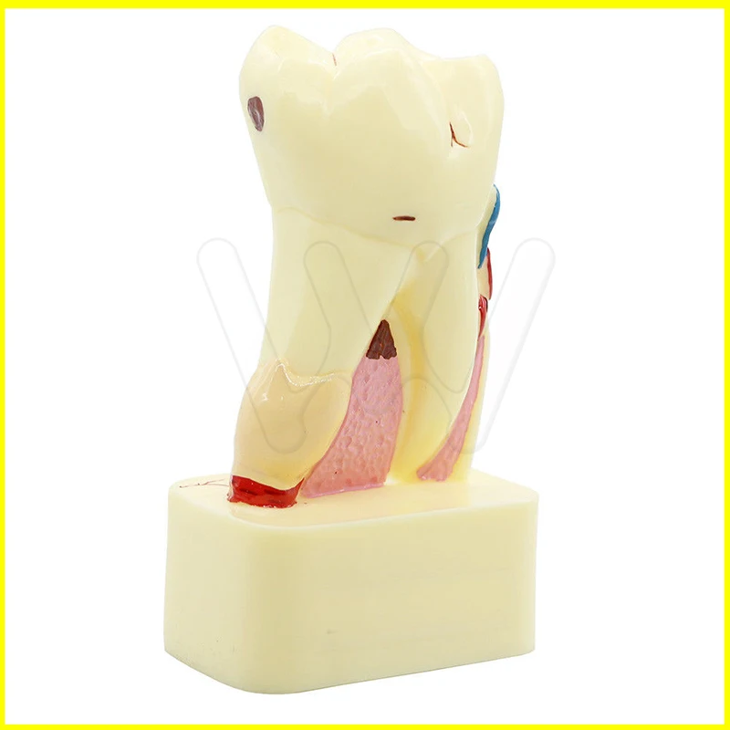 

tooth model dental pathology teeth model, dental caries, calculus, pulp stones, Occlusal tooth wear