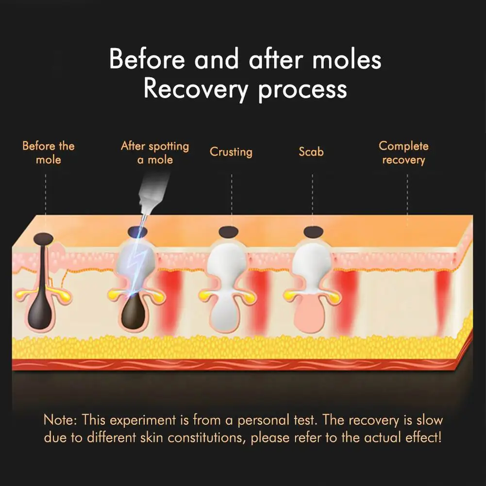 Laser de Remoção de Toupeira Remoção de Toupeira Cuidados com a Pele Removedor de Mancha Caneta Plasma Tatuagem Verruga Freckle Facial Remoção Tag Elétrica Escuro Pen 3 Utensílios de cuidado facial