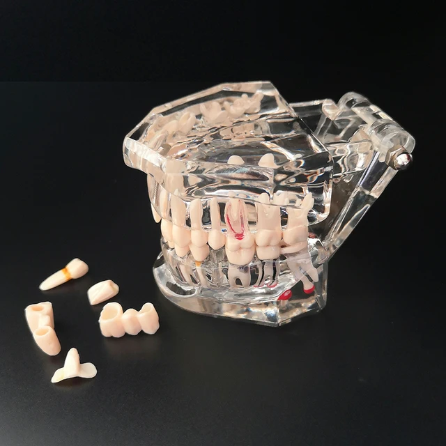 Nowy Model dentystyczny Implant zębów przywrócenie mostu nauczanie studium medycyna nauka choroba dentysta stomatologia produkty 1
