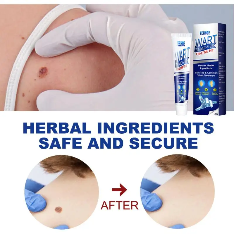 Eelhoe Wart Skin Tag Remover Cream Antibacterial Herbal Extract Foot