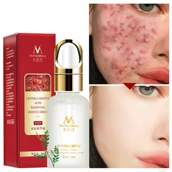 

MeiYanQiong Centella Asiatica Acne Removing Essence Improve Pox Skin Smooth Skin Improves Water And Oil Condition Provides Relie