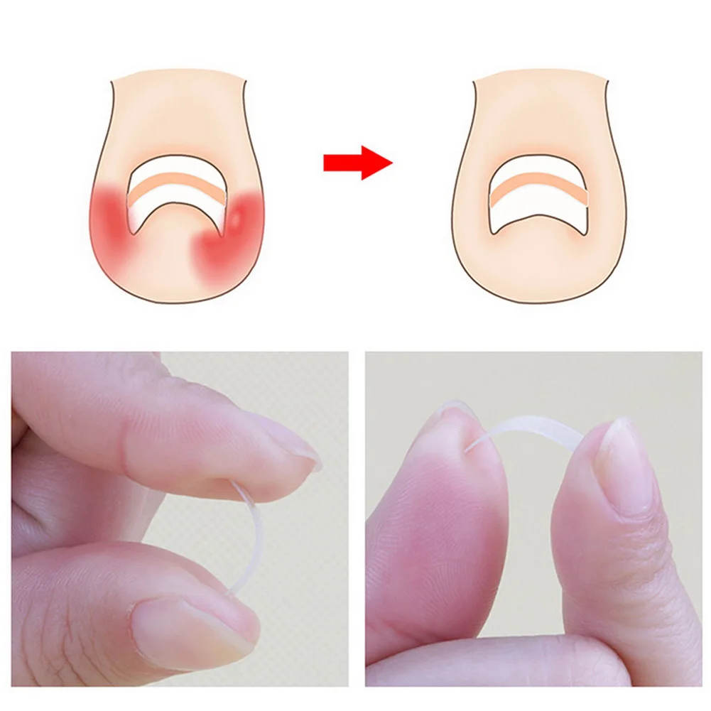 10Pcs Ingrown Toe Nail Correction Sticker Patch Paronychia Corrector File Elastic Patch Corrector Pedicure Foot Care Tool 4mm