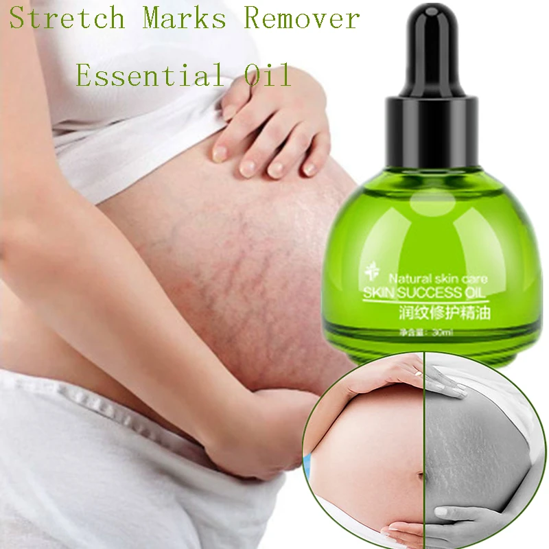 eraser cream for stretch marks