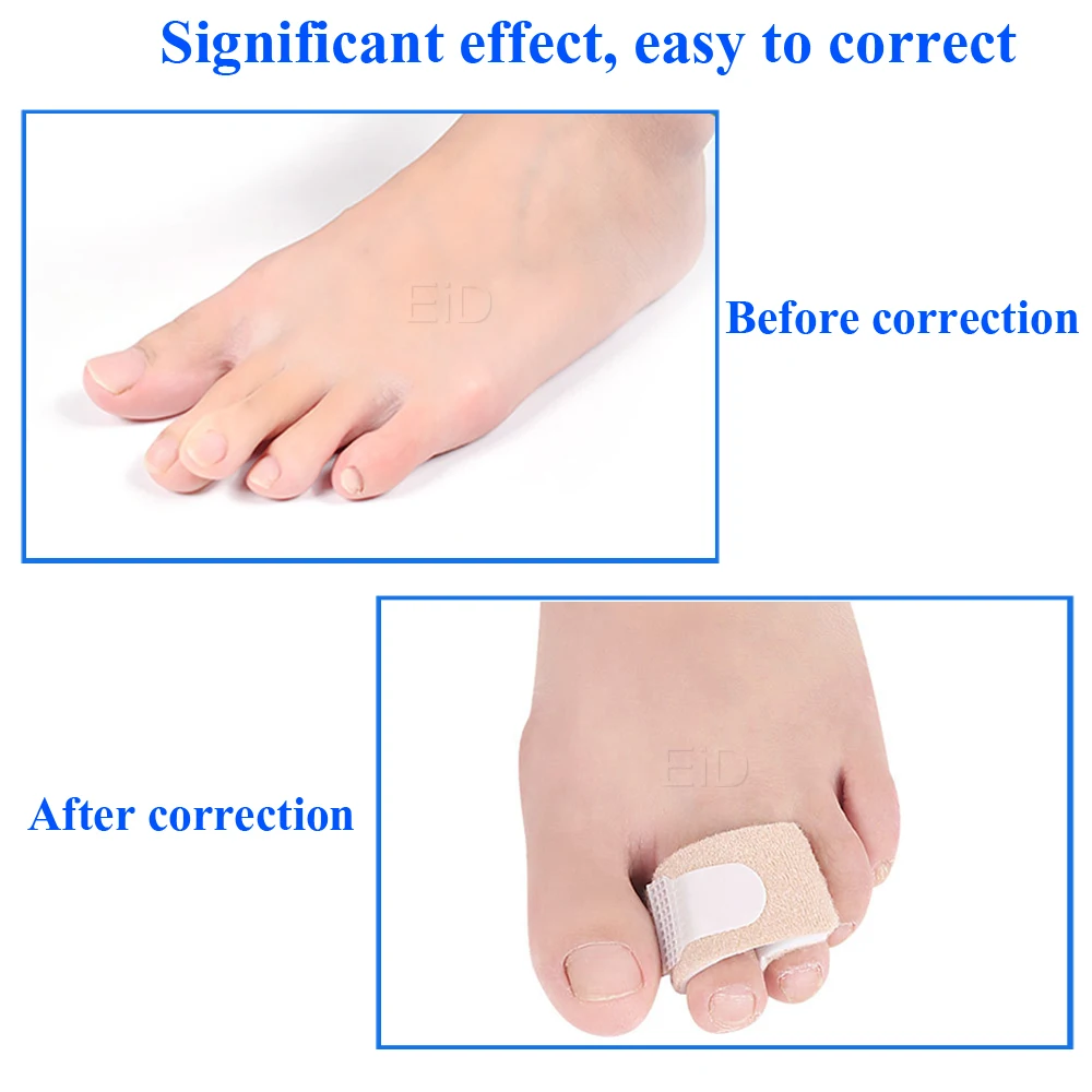 EiD 2Pcs Toe separator Strap for Bunion Splint Hallux Valgus Orthosis Correction Overlapping Spreader Foot Protector Inserts