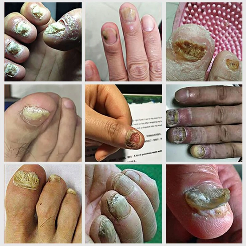 Nail Fungus Treatment Essence Serum Care Hand and Foot Care Removal Repair Gel Anti-infective Paronychia Onychomycosis