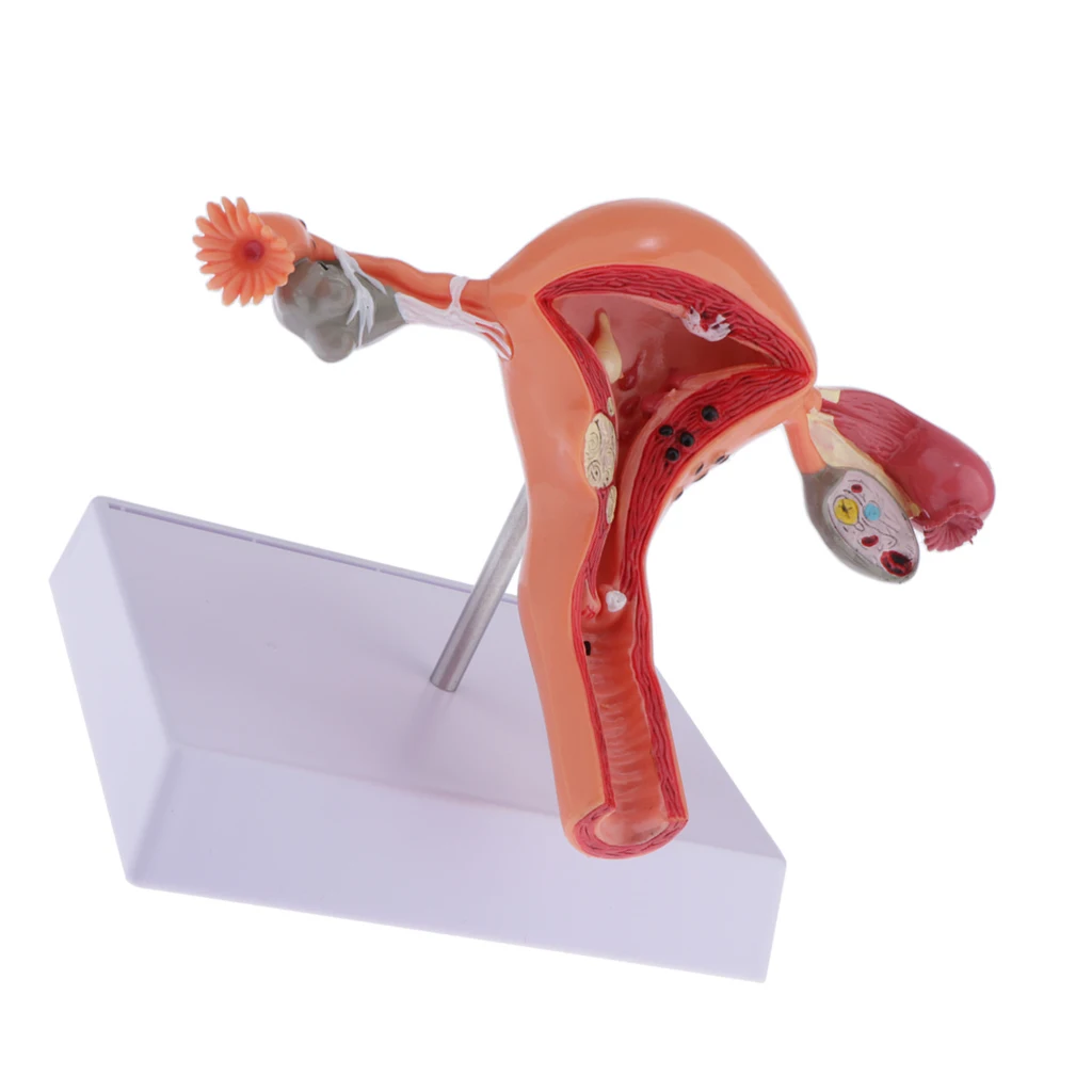 Human Female Uterus Ovary Anatomical Model With Pathologies, 1:1 Life Size, Lab Supplies Decoration