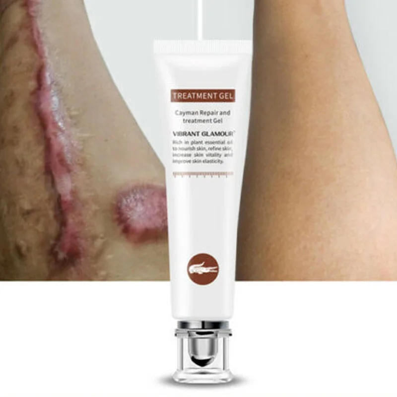 

2019 Repair Scar Cream Remove Acne Scars Stretch Marks Surgica Scar Gel Skin Treatment 20g