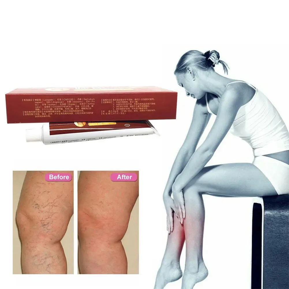 20g Varicose Veins Treatment Cream Ointment Vasculitis Inflammation Chinese Herbal Leg Massage Varicose Veins Removal Plaster