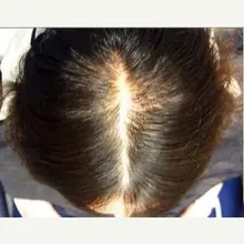 Productos para la pérdida de cabello, Productos naturales sin efectos secundarios para el crecimiento rápido del cabello y el rejuvenecimiento del cabello