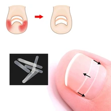 Наклейка для коррекции вросших ногтей Fixer Paronychia Recover Toenail эластичная заплатка корректор для ухода за ногами педикюрный инструмент 10 шт