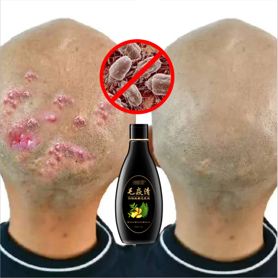 Scalp Hair Follicle Shampoo Antibacterial Antiitching Mites Oil