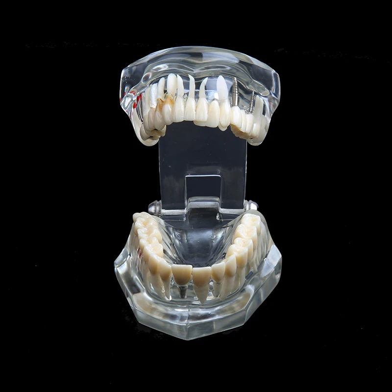 Зубные имплантаты модель зубов с реставрации мост палочки для очистки зубов для медицинских исследований Стоматологическое заболевание обучения, изучения