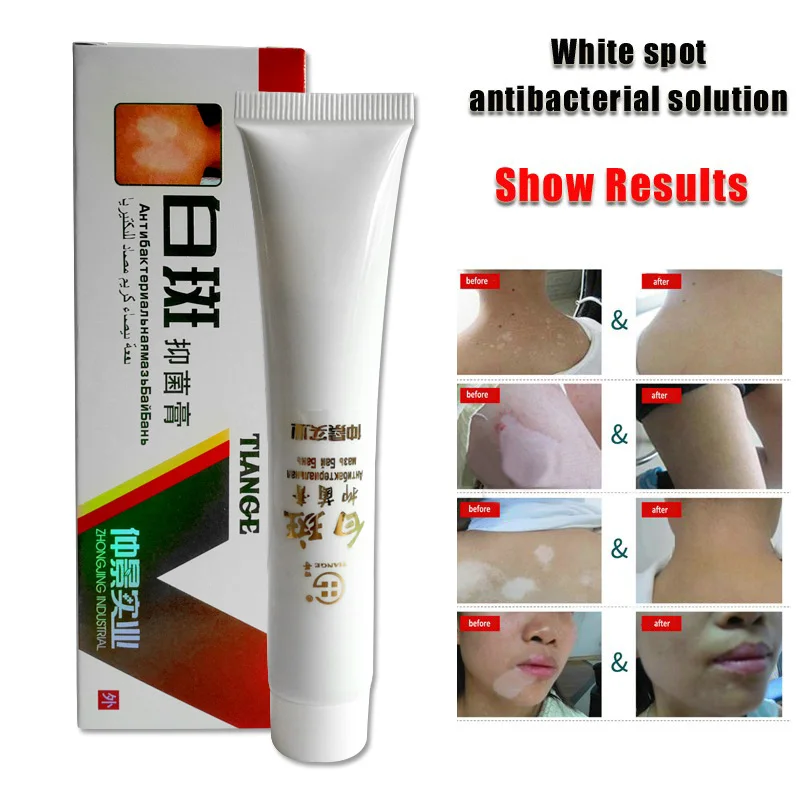 

Good Healthy Chinese Herbal Cream for Vitiligo White Spots Leukoplakia Disease Treatment