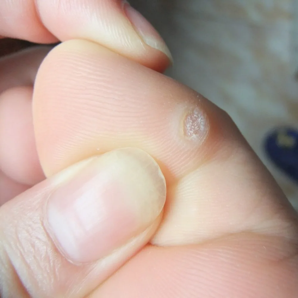 Foot Corn Removal Paster Painless Calluses Plantar Warts Thorn Patch