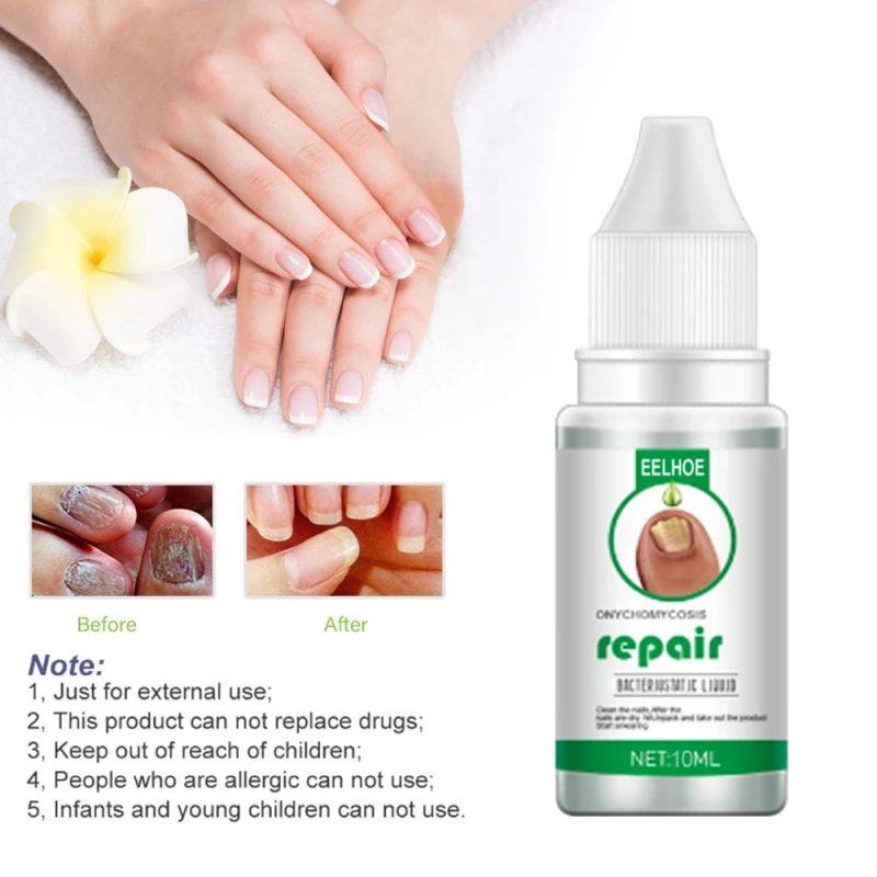 30 Ml Fungal Nail Repair Essences Serum Toe Nail Fungus Treatments