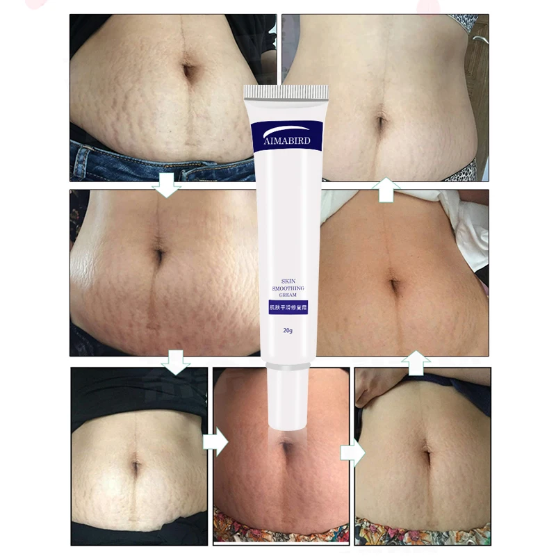 

Smooth Skin Cream Fat wrinkles Pregnancy Removal To Maternity Skin Repair Body Cream Soft Skin Stretch Mark Scar Removal Creams
