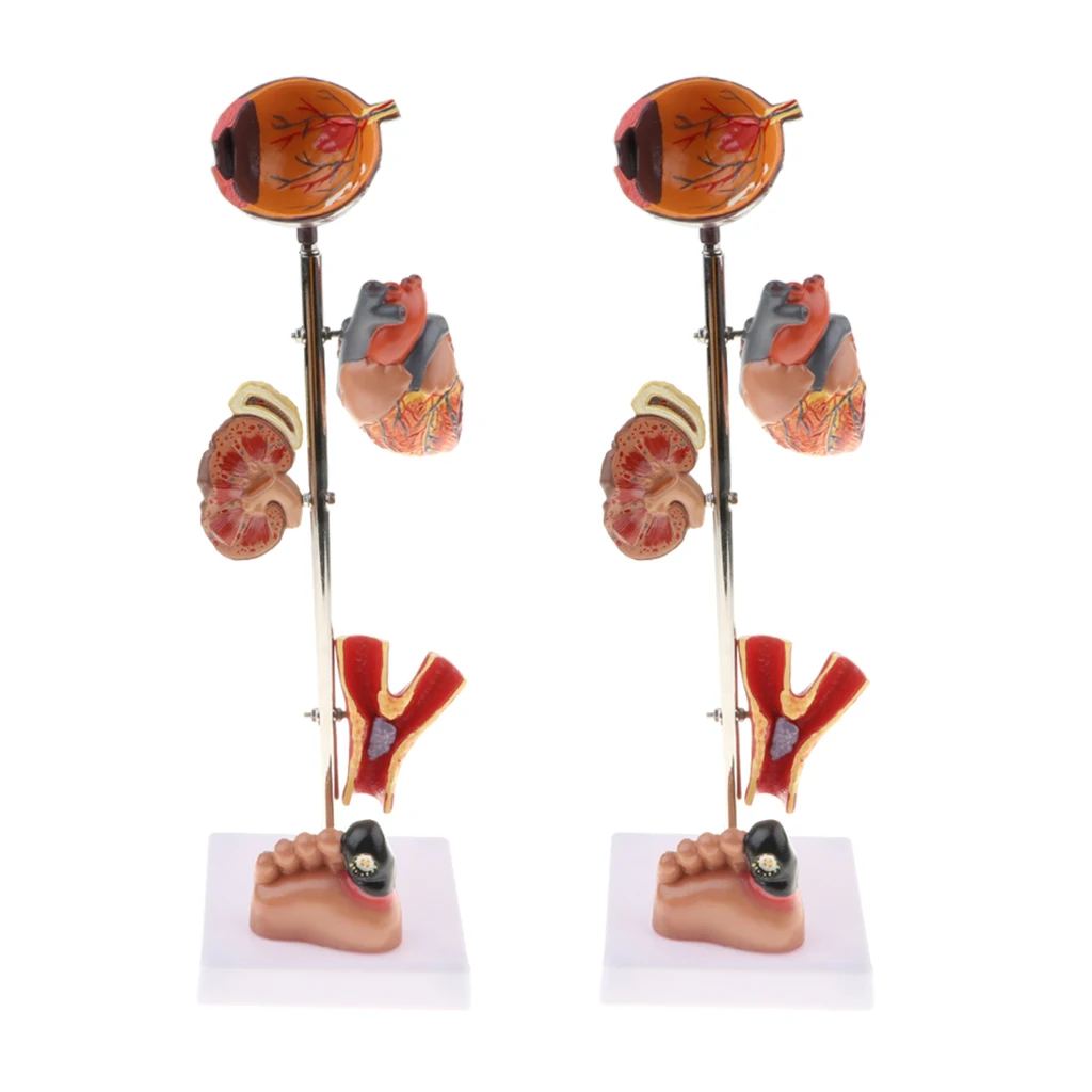 

2pcs Scientific Pathological Diabetes Model, 5 Part Anatomy Medical Model for Lab Equipment Demonstration Tools