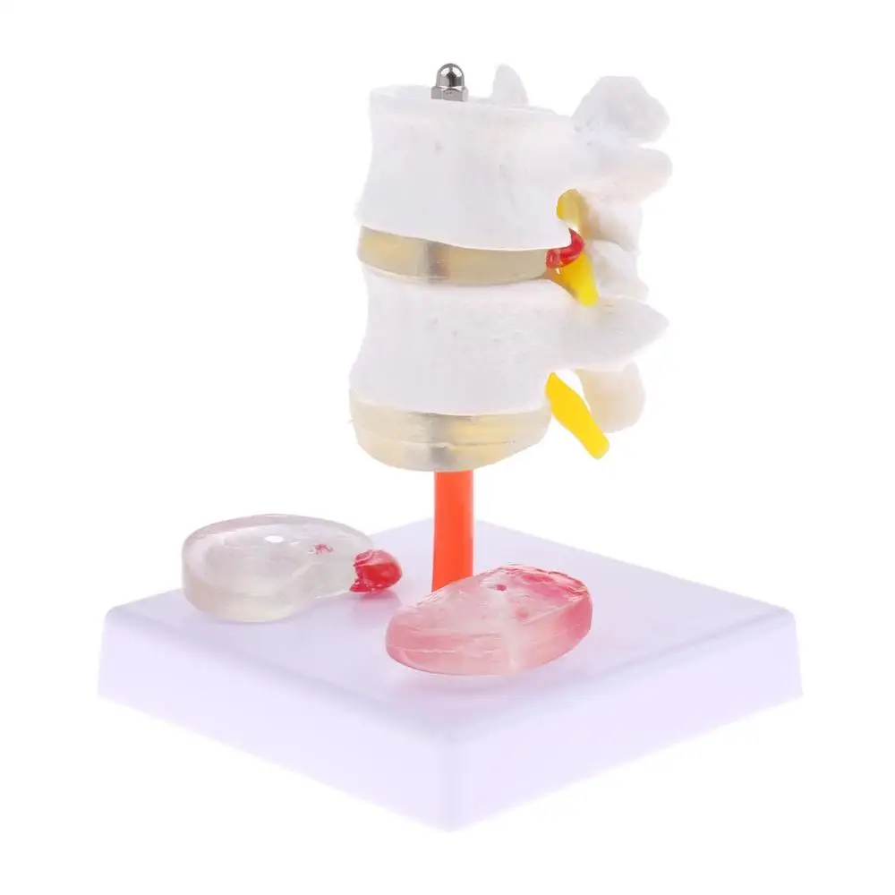 

Human 2 Lumbar Vertebra with Diseased Intervertebral Disc Model Medical Skeleton