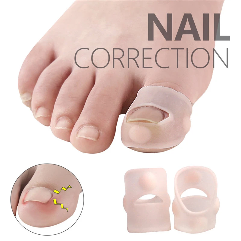 Share more than 130 pincer nail correction diy super hot ceg.edu.vn