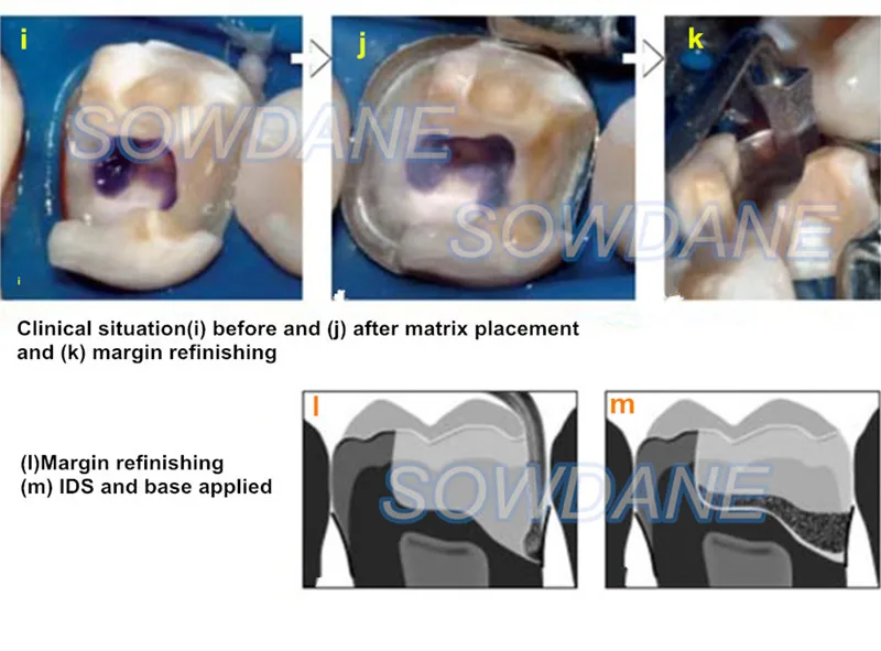 Dental-Tofflemire-Matrix-for-Deep-Margin-Elevation-Large-Curvature-Matrices-Retainer-Sectional-Contoured-Matrice-dental-Material (3)