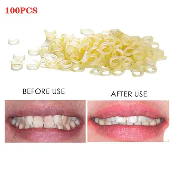 

VIBRANT GLAMOUR 100pcs Dental Materials Disposable Rubber Ring 6.35mm Ligation Ring