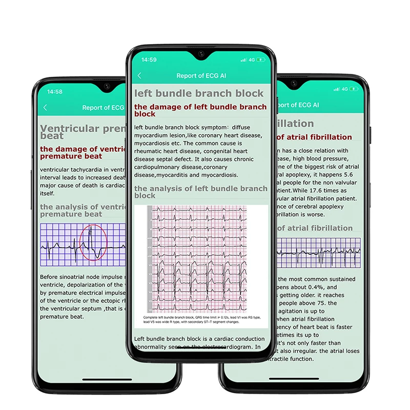  PPG ECG Ʈ ġ ü ɹڼ   Smartwatch 1.7 ġ Ǯ ġ  