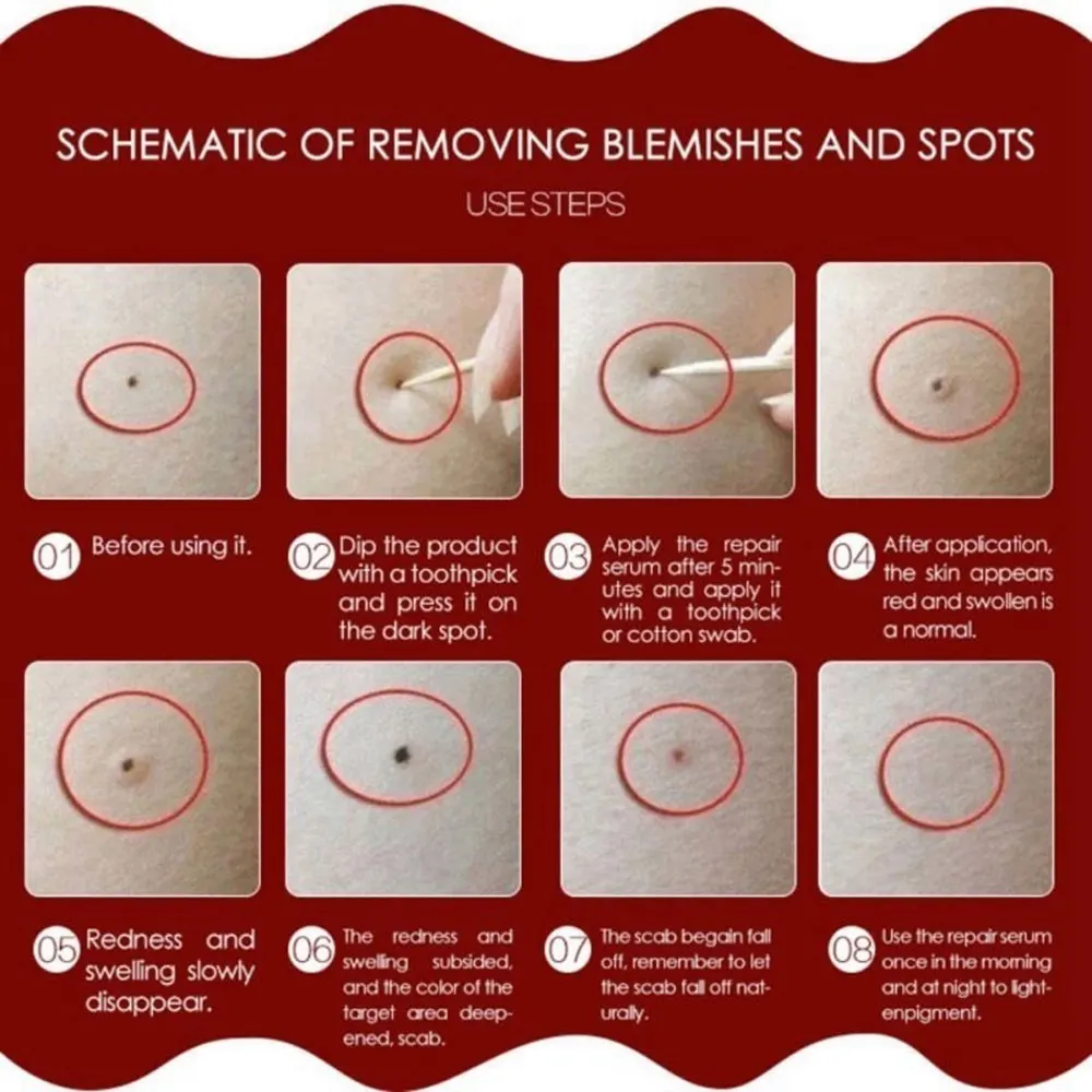 Моль метка на коже раствор для удаления веснушек безболезненное удаление уход за лицом масло штукатурка пятно от акне согревает уход восстановление решение