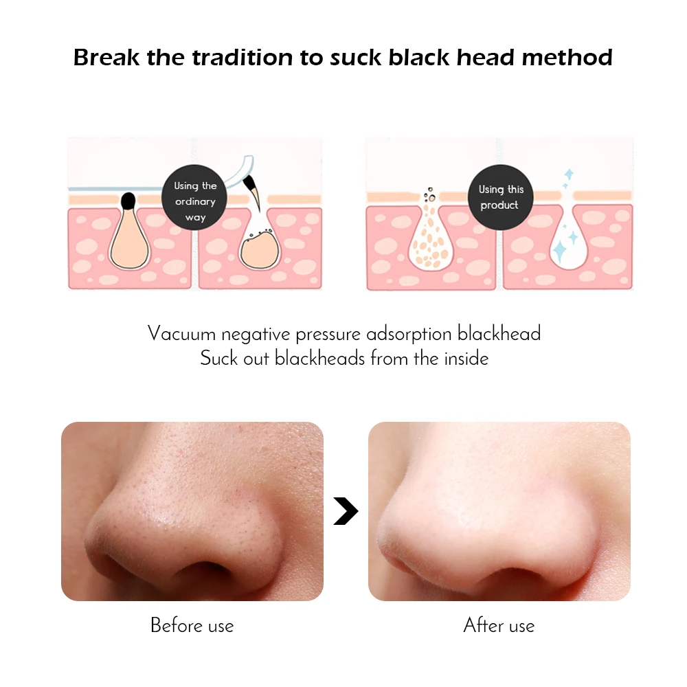 Face Acne Black Dot Pimple Blackhead Remover Electric Microcrystalline Blackhead Vacuum Cleaner Pore Blackhead Skin Care Machine - Image 4