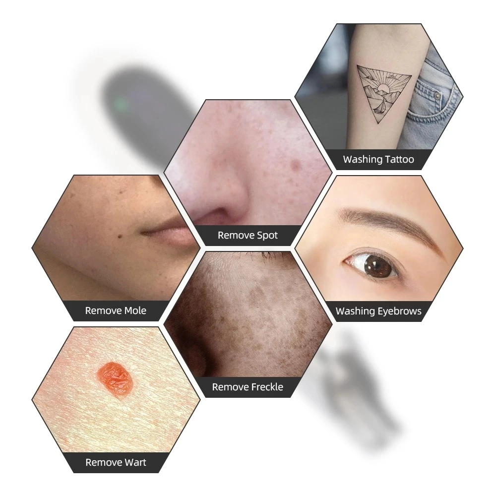 Newest Neatcell Handheld Picosecond Laser Tattoo Removal Profesional  Machine 9+9 Upgrade Mole Tattoo Wart Remover Pen Fade Line|Home Use Beauty  Devices| - AliExpress