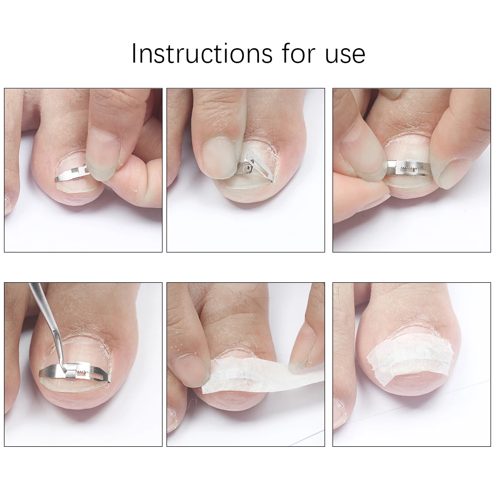 1Set Ingrown Toe Nail Correction Tool Toenail Straightening Correctors Patch Tool Kit Nail Repairer Orthosis Beauty Tools