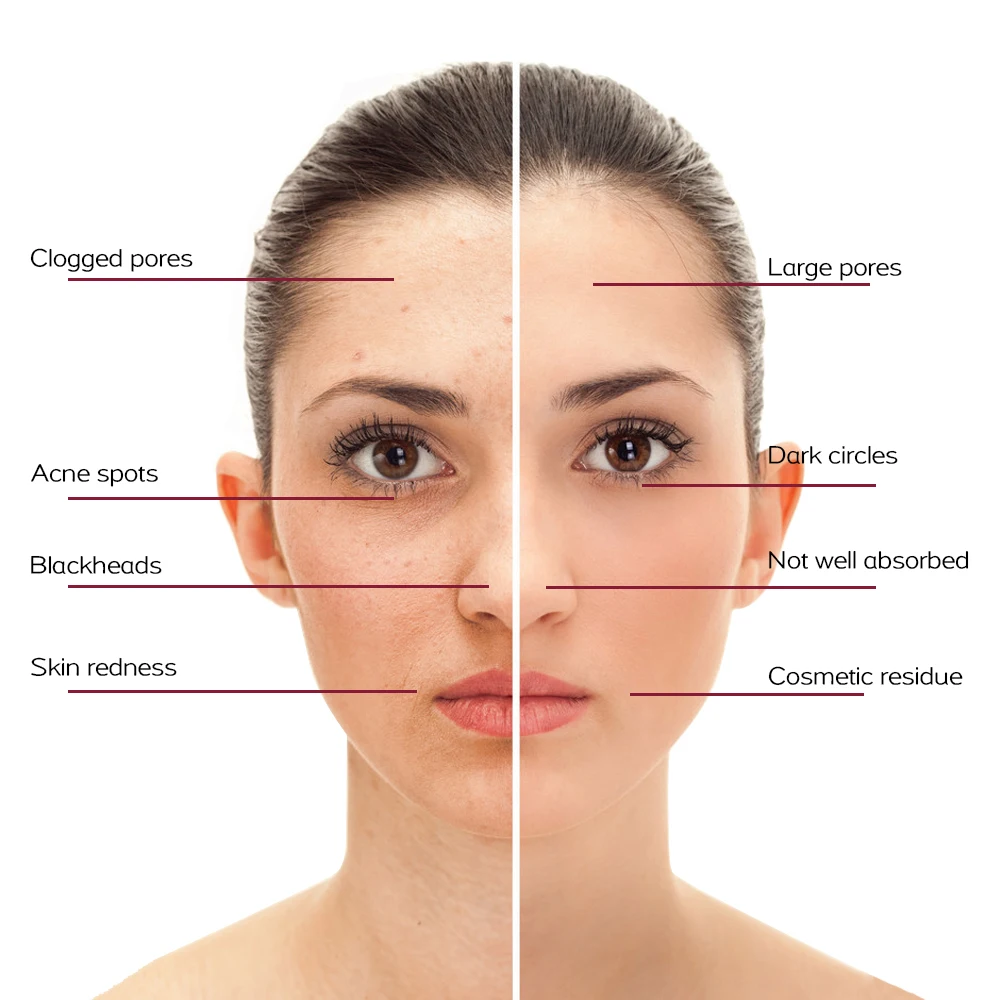 Skin Care Laser Pen Skin Tag Remover Pen Tattoo Freckle Mole Removing