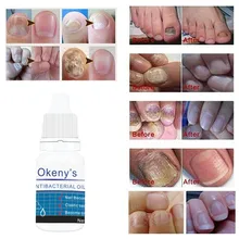 Ремонт ногтей Лекарственное Масло для лечения грибка ногтей для ногтей и ногтей против грибка onychomicosis Paronychia удаление