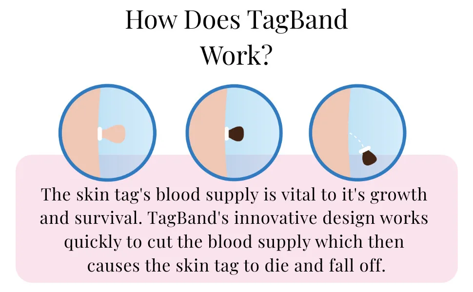 How To Get Rid Of Skin Tags