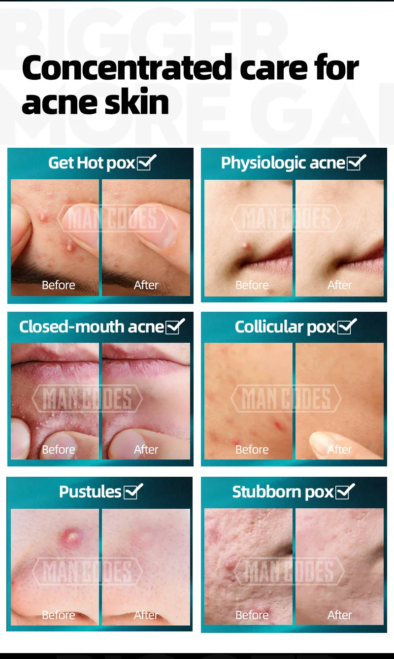 左颜右色祛痘膏-水印_05