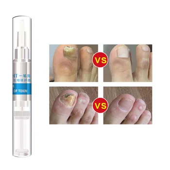 

1pc Nail Repair Pen Grey Nail Treatment Premium Whitening Toe Care for Nail
