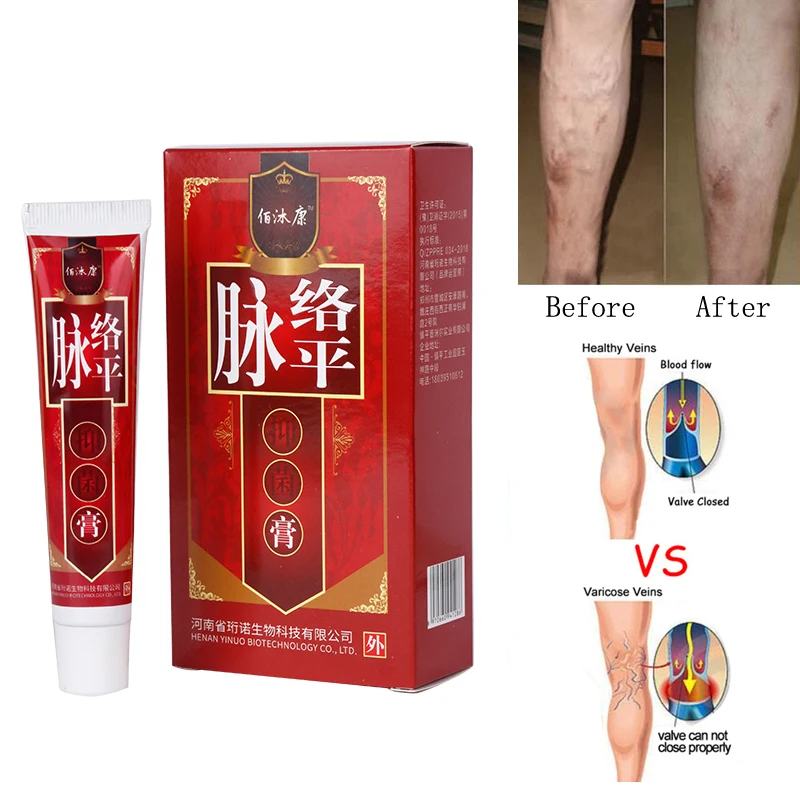 Varicose Veins Treatment Cream Ointment Vasculitis Phlebitis Spider Pain Varicosity Angiitis Remedy Removal Herbal | Красота и