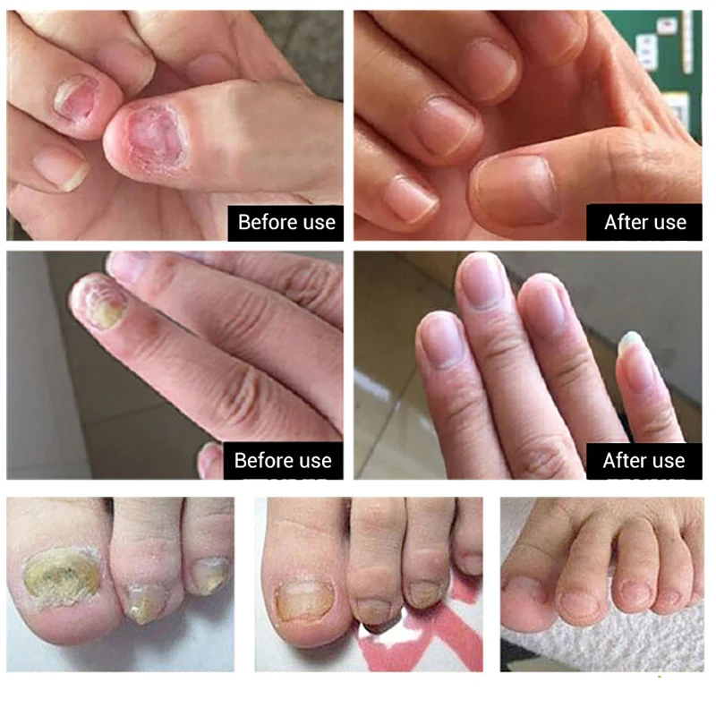 2 шт./лот грибковое Лечение ногтей Onychomycosis Paronychia Уход за ногами эссенция для удаления грибка ногтей Травяной Уход лекарственная жидкость