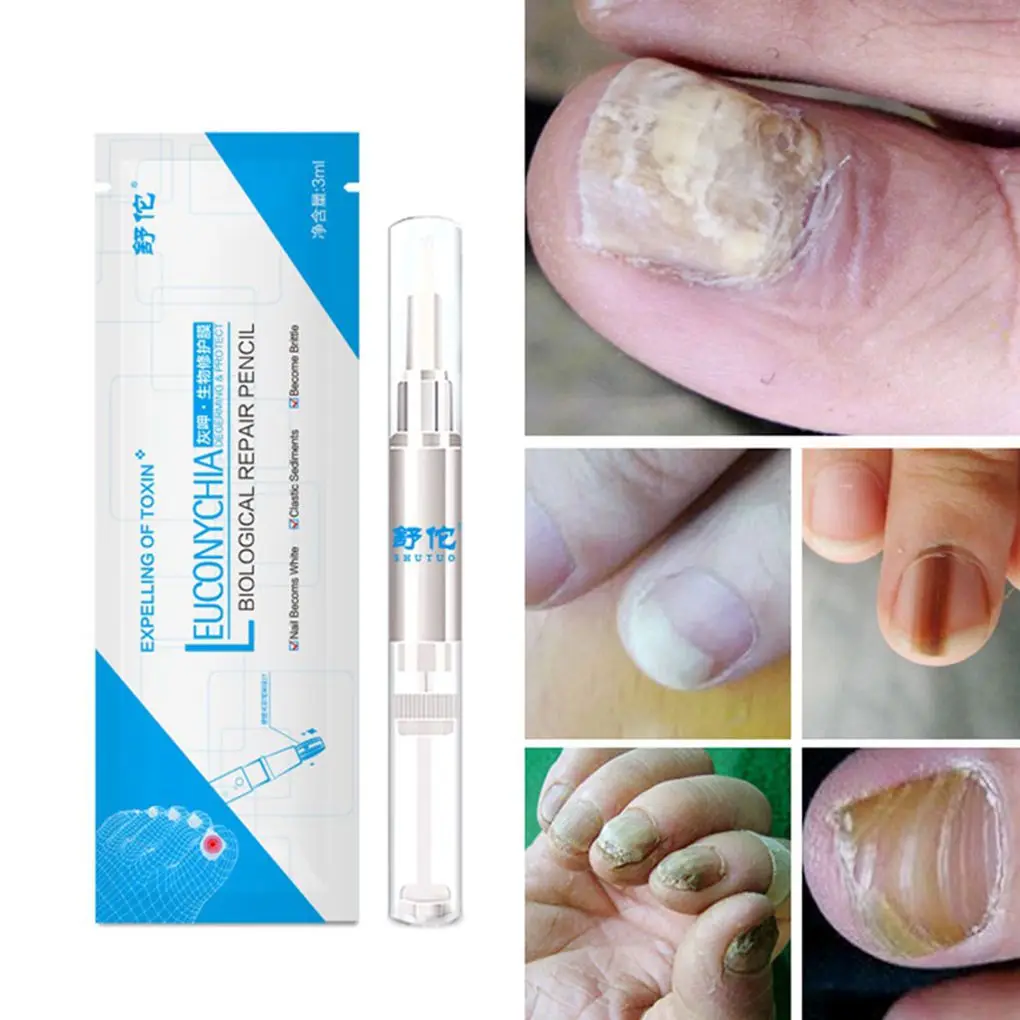 3 мл ручка для лечения Ногтей Onychomycosis Paronychia противогрибковые инфекция ногтей