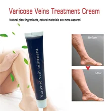 

Varicose Veins Treatment Cream 100% Original Vasculitis Phlebitis Spider Pain Relief Ointment Medical Cream