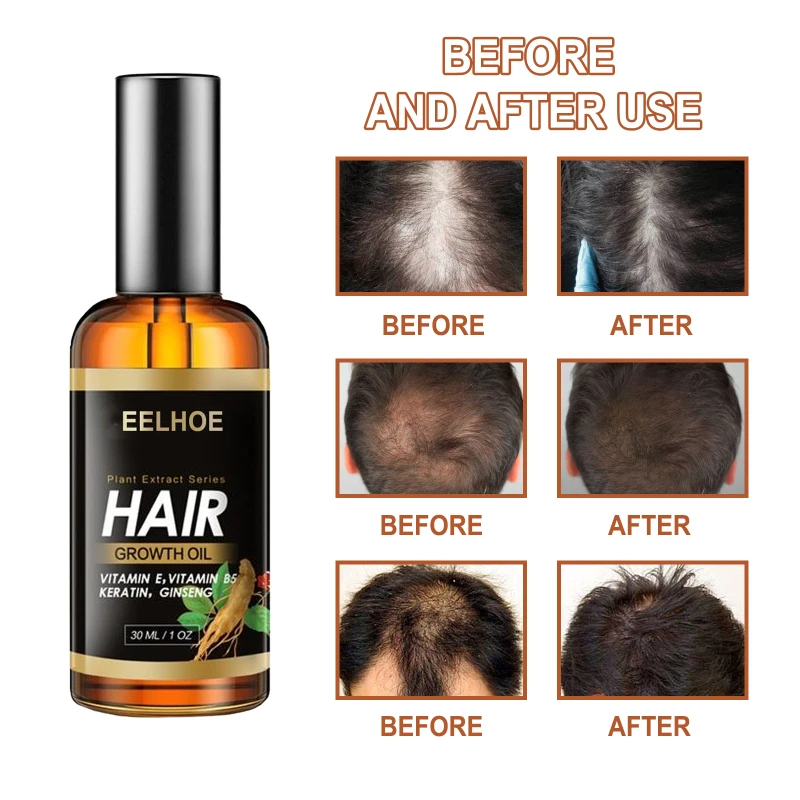 eelhoe hair growth oil