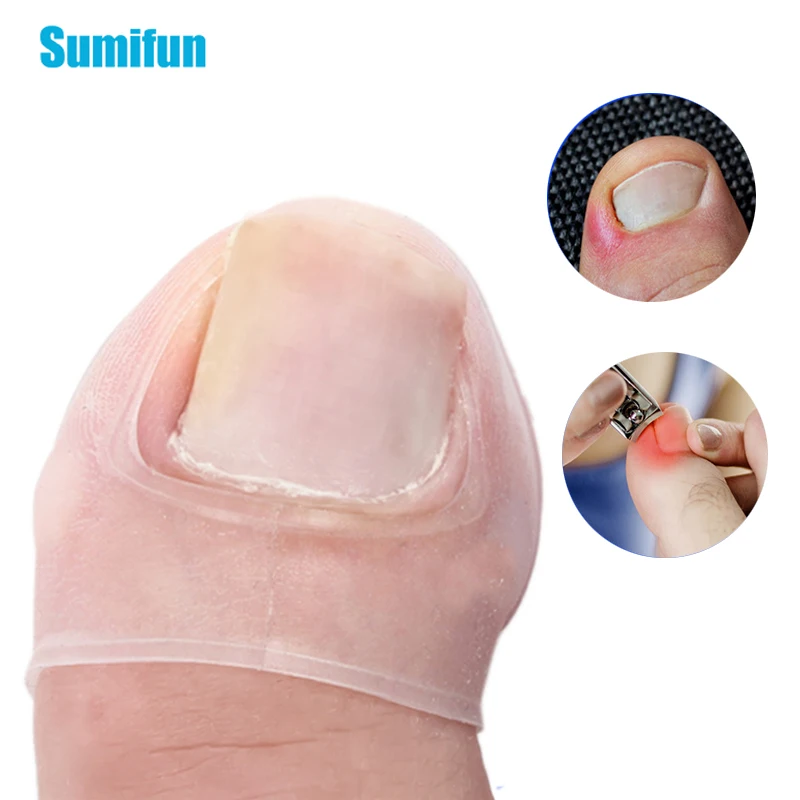 2pcs Silicone Paronychia Invisible Nail Acronyx Orthotics Patch Ingrown Toe Nail Correction Patch Foot Care Treatment Pedicura 2pcs lot new originai fm18l08 70 sg 1808 70 sg 18w08 sg 16w08 sg sgtr 1608 120 sg sop28 patch memory